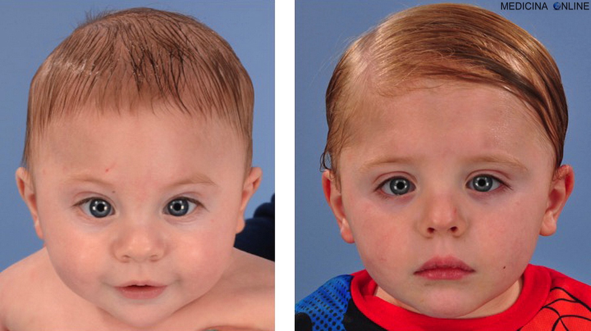 аденоидный тип лица у детей фото
