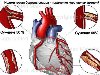 Ишемическая болезнь сердца - Симптомы и лечение