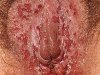 Герпес половых органов: первичная инфекция. Множественные эрозии на вульве и ...