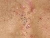 Импетиго - это распространенное заболевание кожи, вызванное инфекцией.