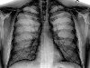 Chest X-ray PA inverted and enhanced.