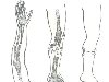 Переломы костей конечностей сопровождаются их укорочением и искривлением в ...