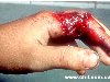 Травма 2 пальца кисти