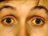 Почему глаза желтые? Онкологические заболевания. почему белки глаз желтые