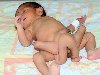 В Пакистане родился мальчик с шестью ногами